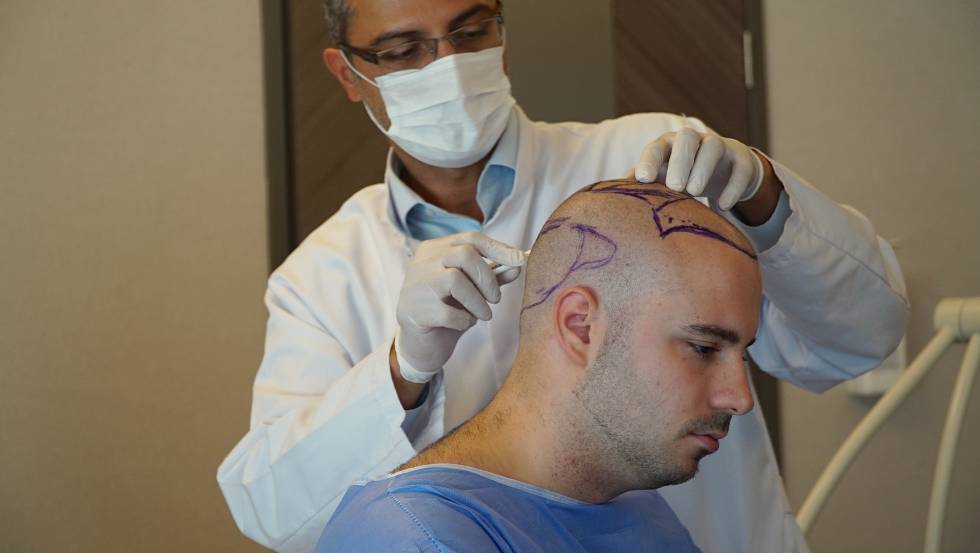 Hair Restoration Consultation