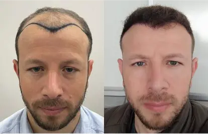 Before and after hair transplant result 18