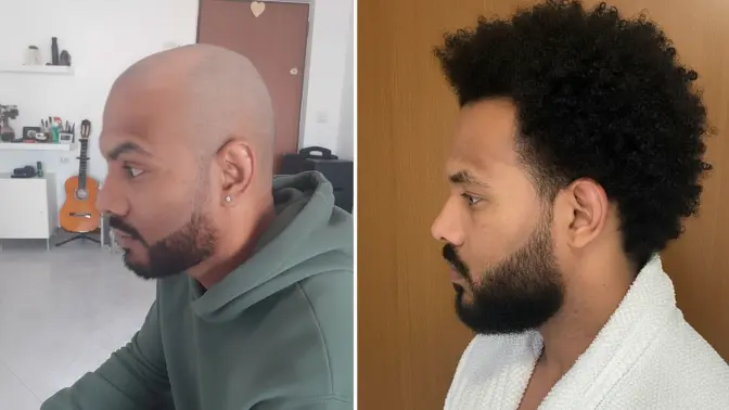 How to Combat Dry Skin in Winter: Tips and Tricks