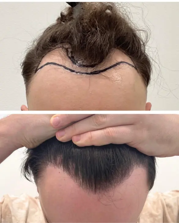 Before and after hair transplant result 20