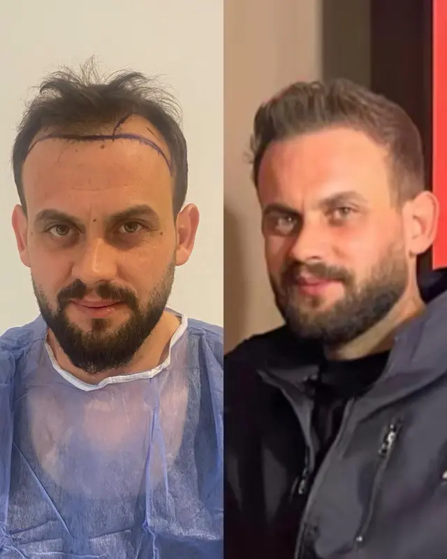 Before and after hair transplant result 25